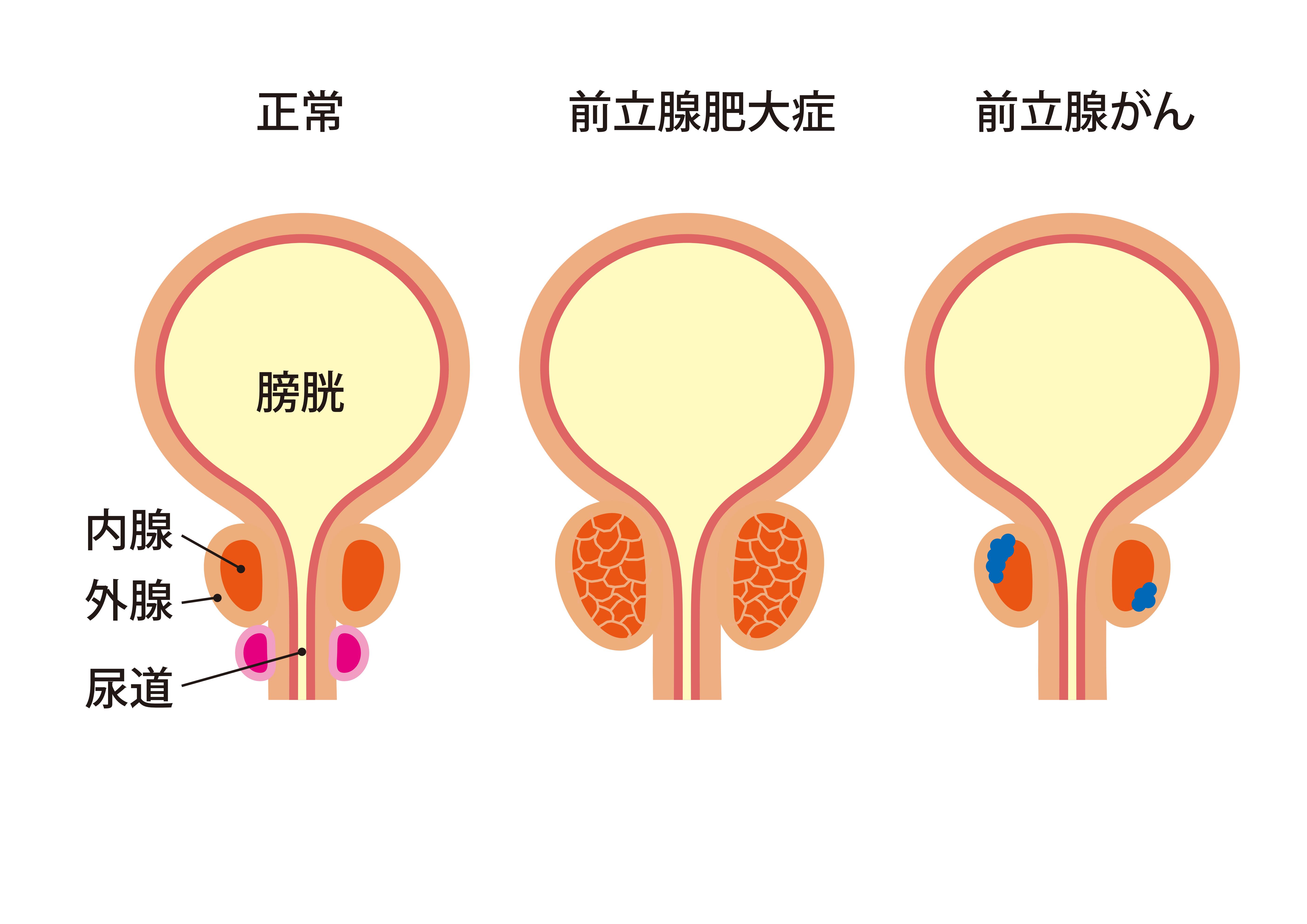 前立腺癌