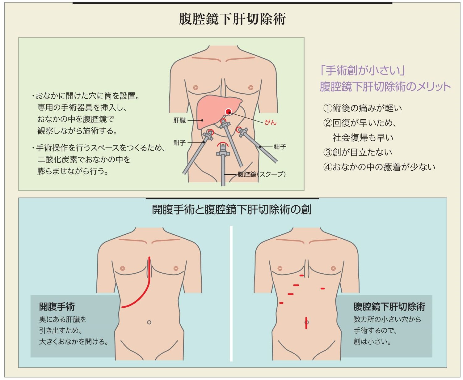 腹腔鏡下肝切除術 | トピックス | 磐田市立総合病院 - Iwata city Hospital